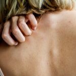 woman suffering from back acne